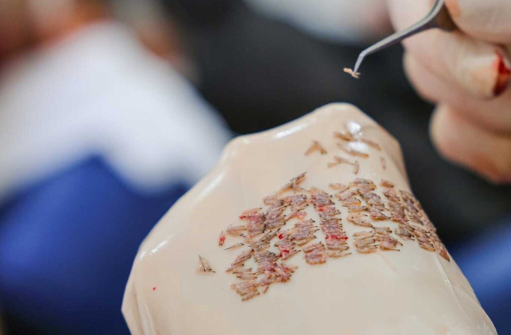 FUE Haartransplantation
