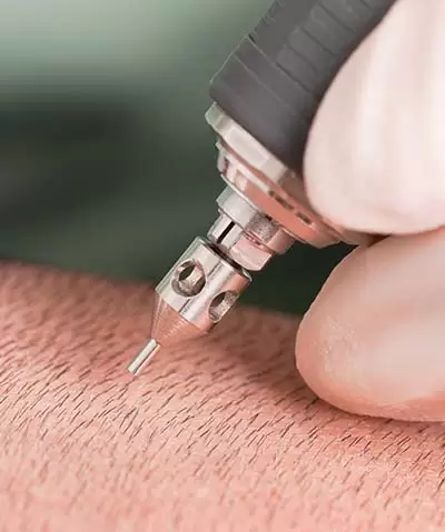 hair transplant